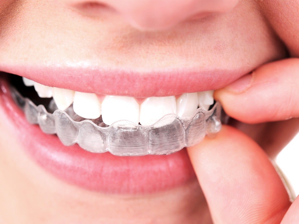 Invisalign Braces Costs Lexington SC. 